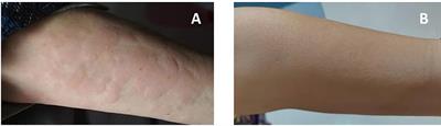 Case Report: Therapeutic Use of Ibrutinib in a Patient With Schnitzler Syndrome